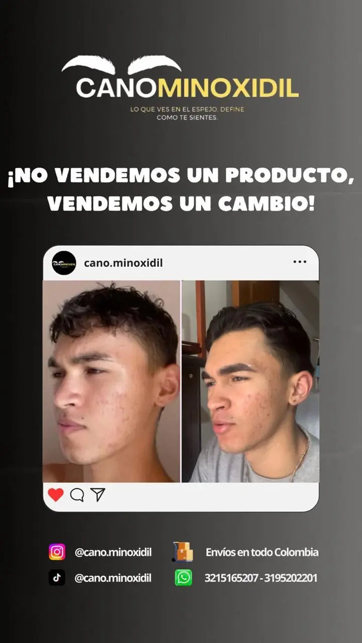 Antes y después de barba con minoxidil, cliente de Cano Minoxidil