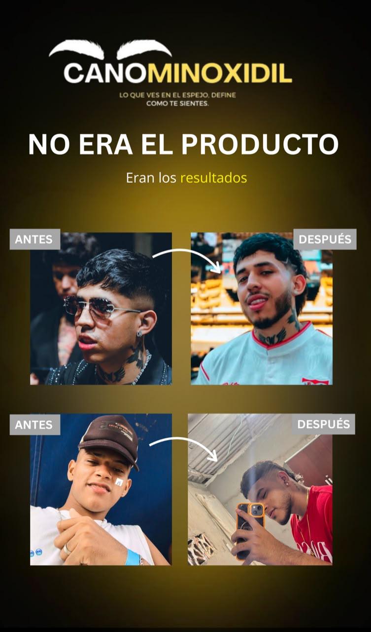 Antes y después de barba con minoxidil, Westcol y cliente de Cano Minoxidil