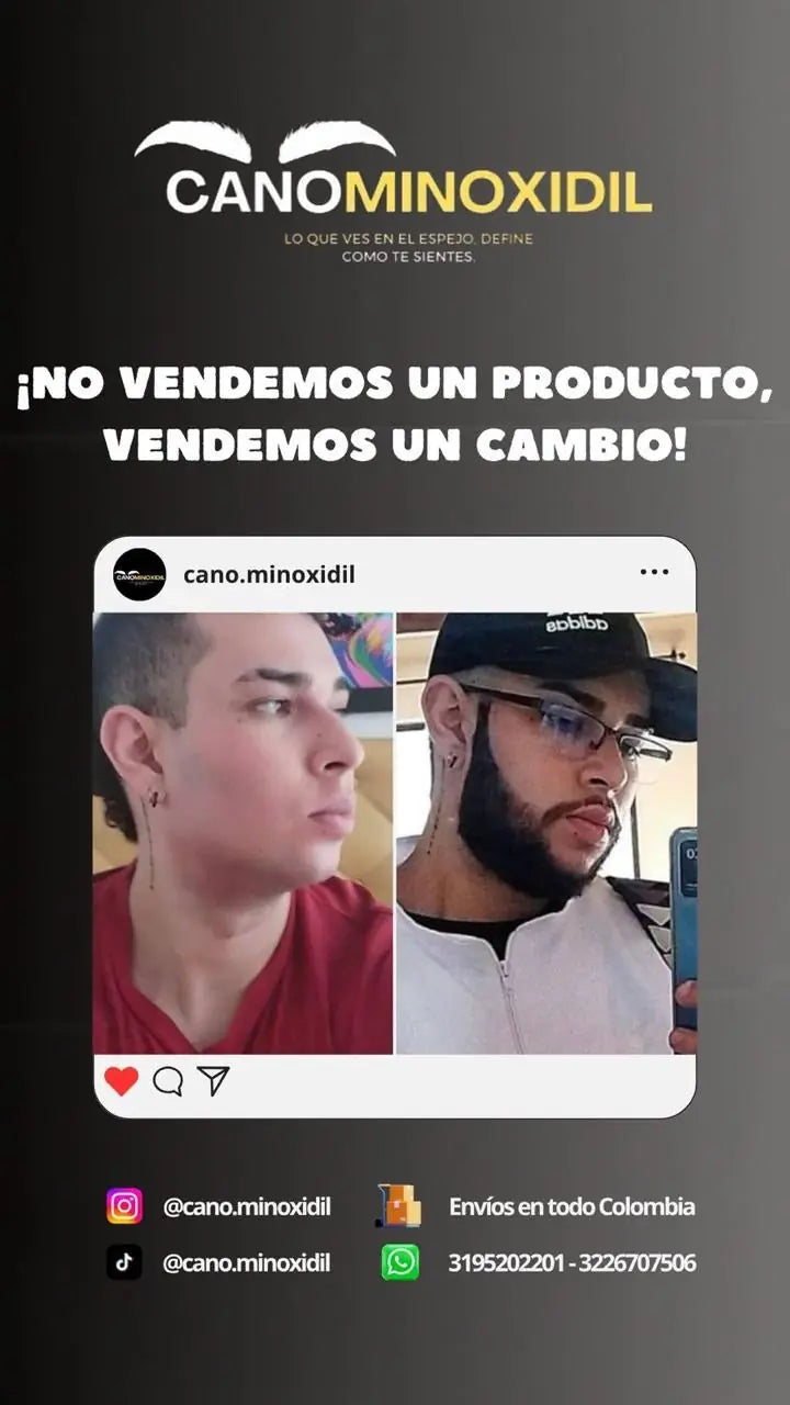 Antes y después de barba con minoxidil, cliente de Cano Minoxidil