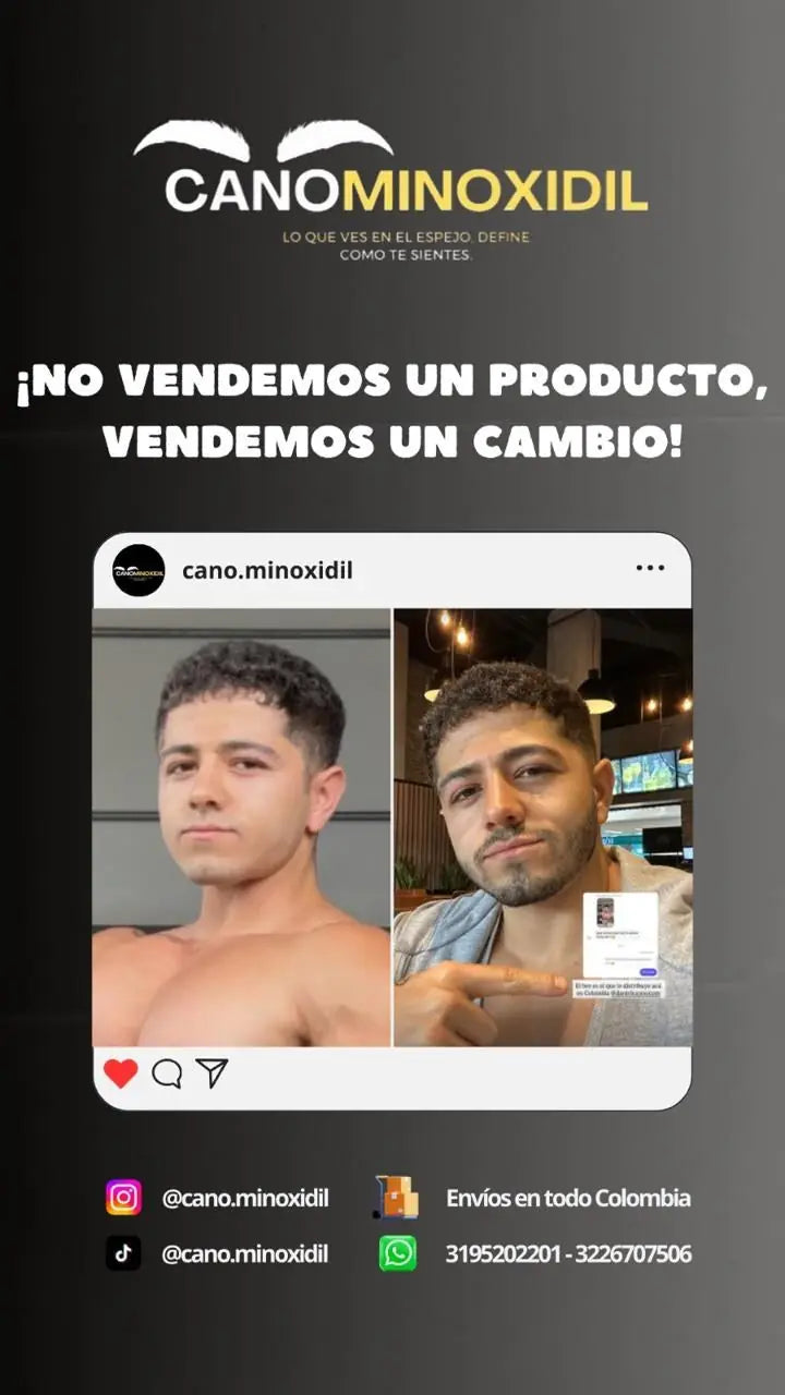 Antes y después de barba con minoxidil, cliente de Cano Minoxidil