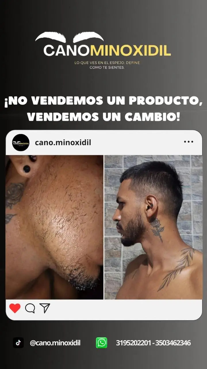 Antes y después de barba, vista lateral, cliente de Cano Minoxidil