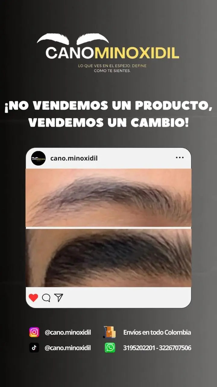 Antes y después de cejas con minoxidil, clienta de Cano Minoxidil