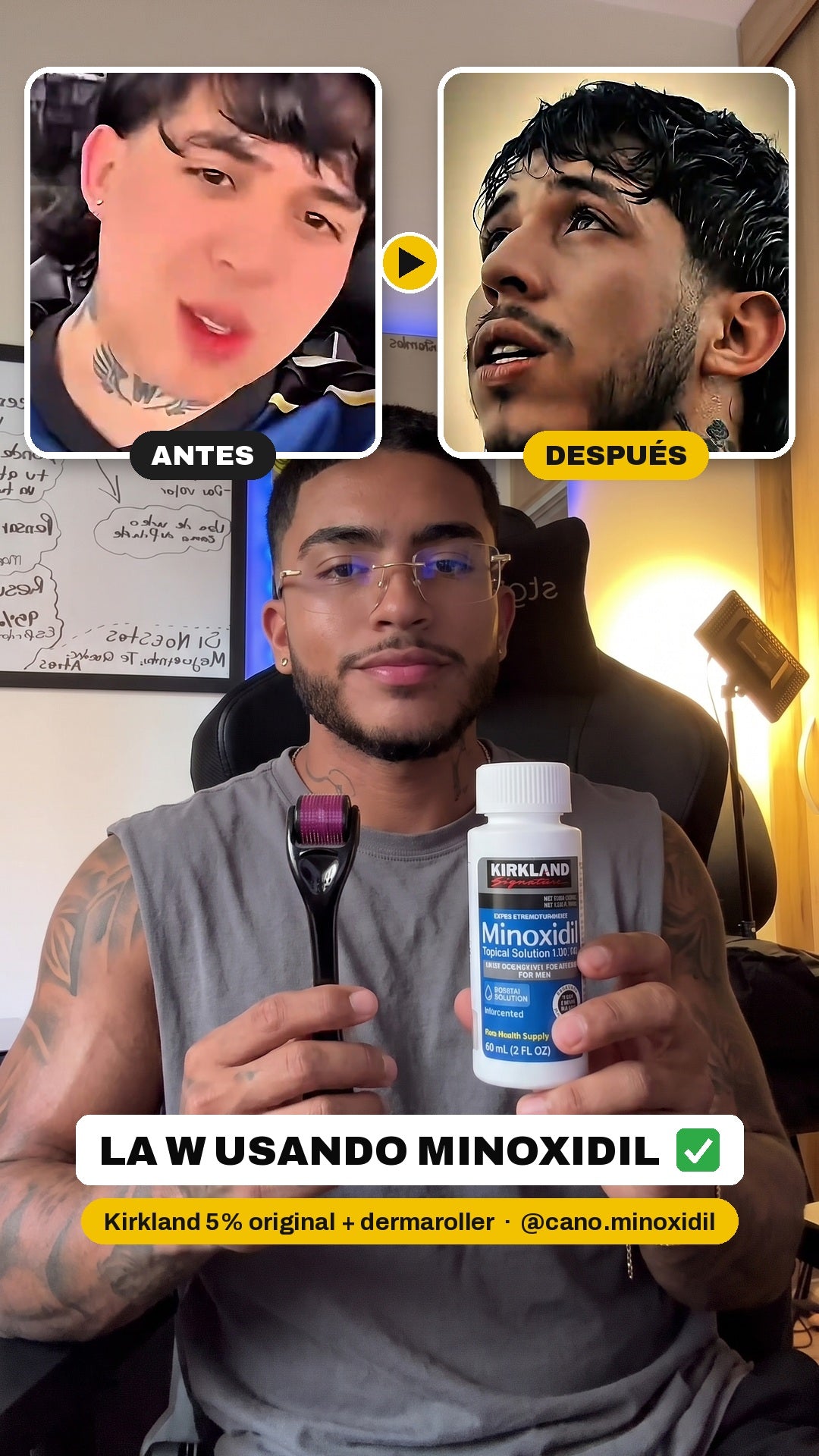 Wescol usando Minoxidil Kirkland 5%